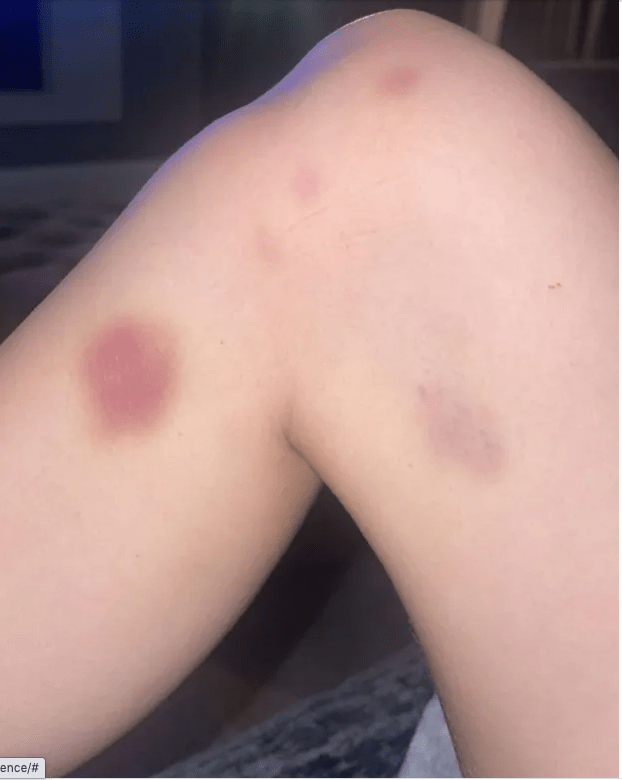 Deep purple bruises covered her arms and legs