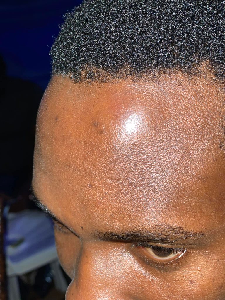 Tamale Mirundi showing off swollen face