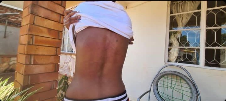Sandra Teta showing off bruises sustained from Weasel's beatings